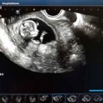 First trimester symptoms chart showing normal changes and warning signs.