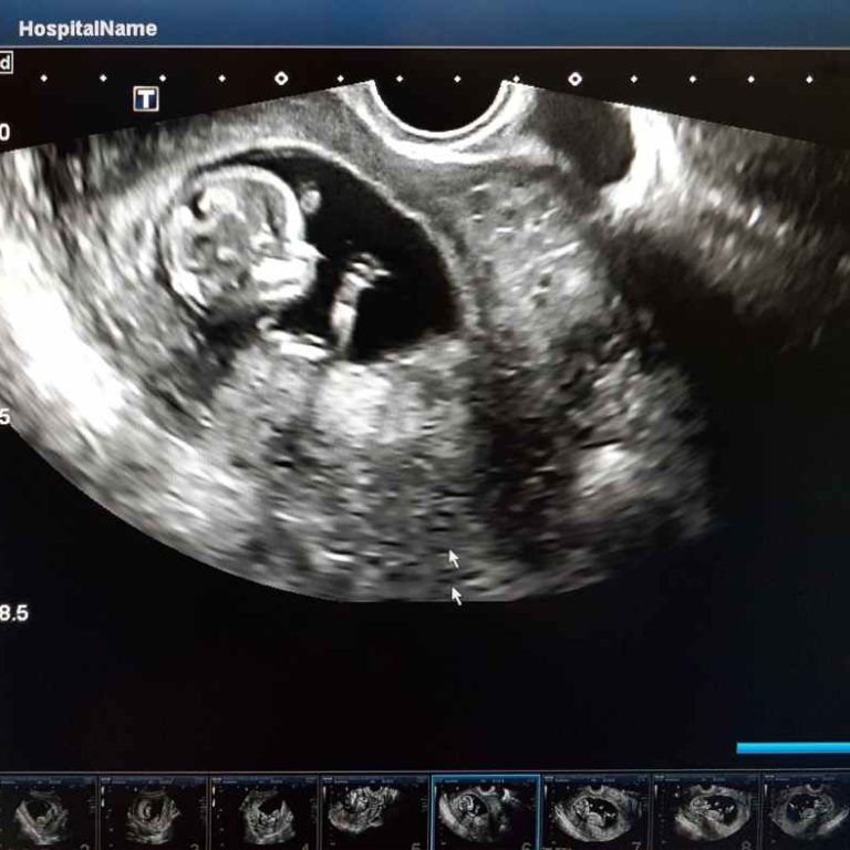 First trimester symptoms chart showing normal changes and warning signs.